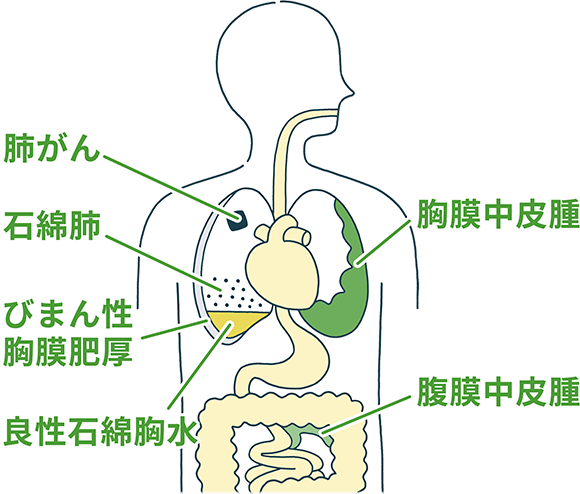 アスベスト（石綿）が原因と思われる疾患にかかっている