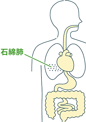 石綿肺